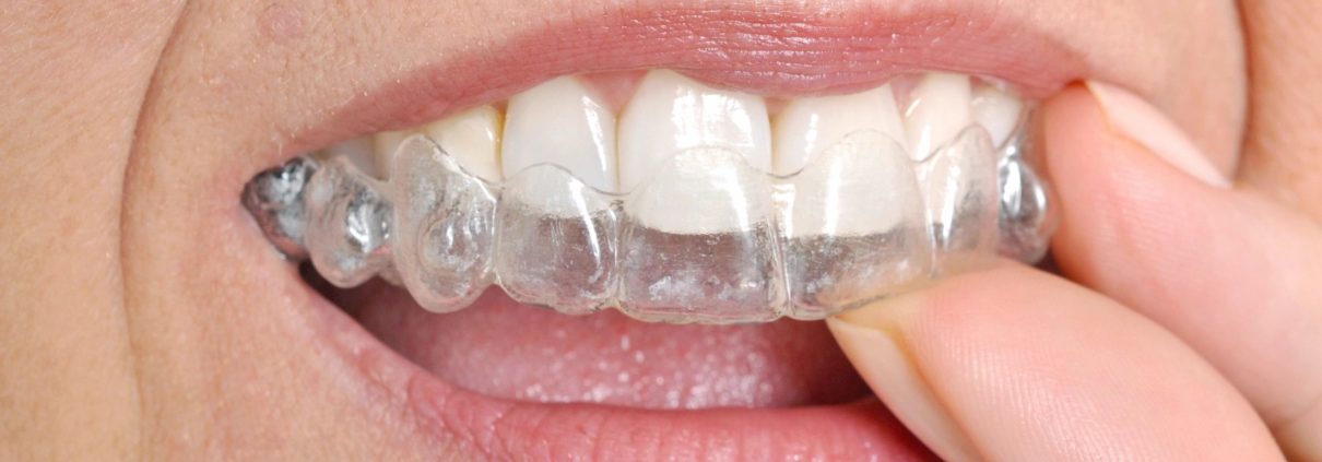 Invisalign